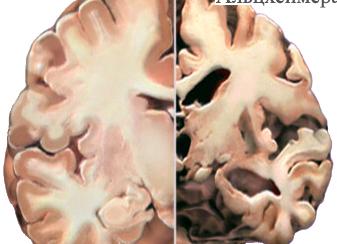 Болезнь головного мозга