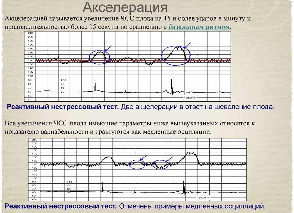 Акцелерации на ктг