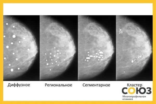 Микрокальцинаты в молочной железе что это