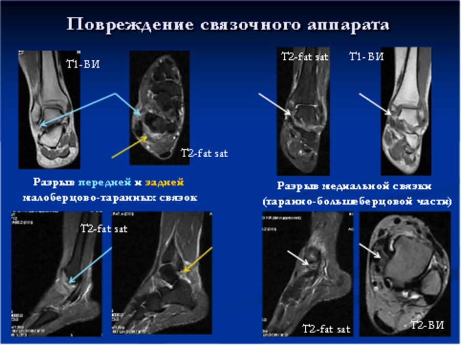 Мрт голеностопного сустава