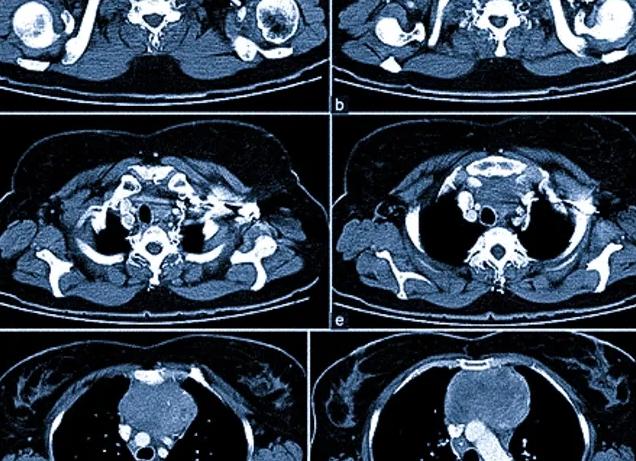 Мрт бронхов и легких