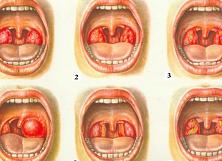Можно ли вылечить стафилококк без антибиотиков