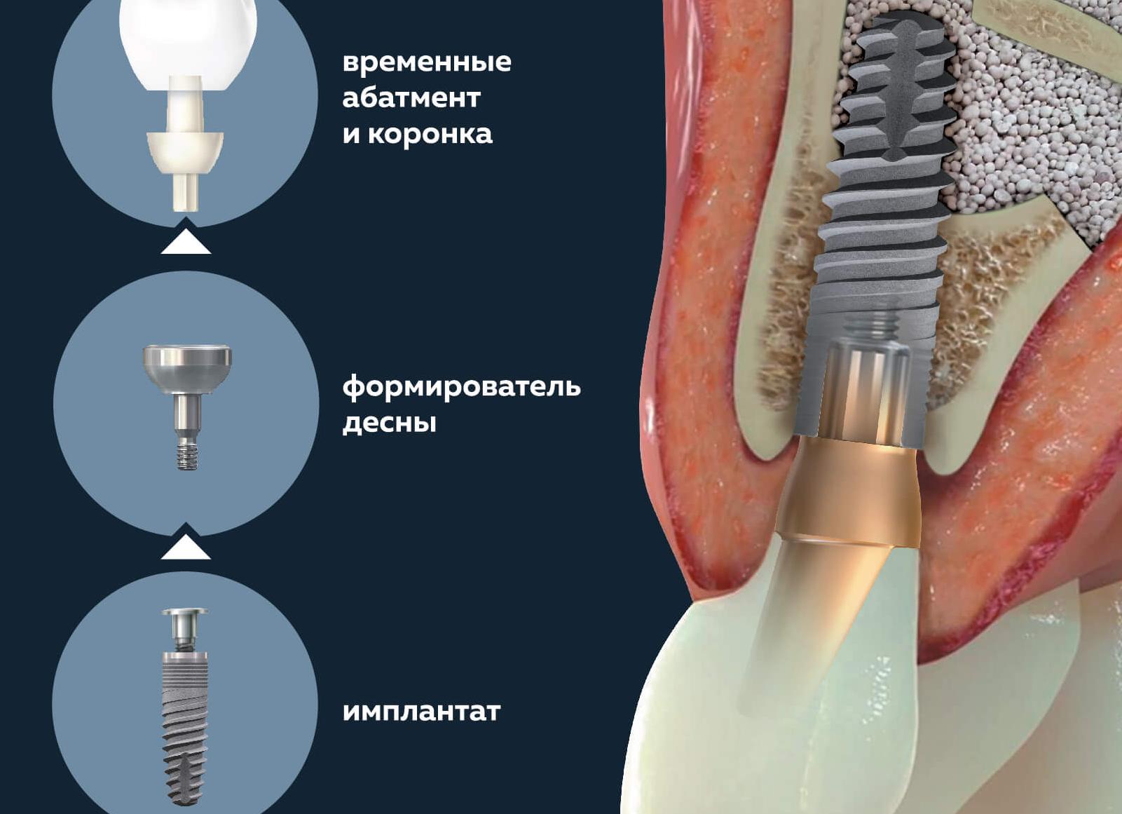Можно ли с имплантами зубными делать мрт
