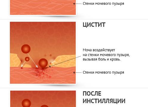 Кровь при цистите у женщин что делать Кровь при цистите у женщин что делать