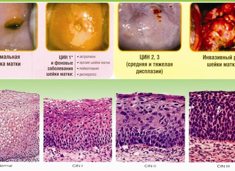 Кольпоскопия шейки матки результаты
