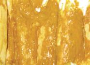 Кал жирный у взрослого