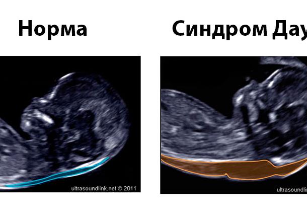 Как по узи определяют синдром дауна
