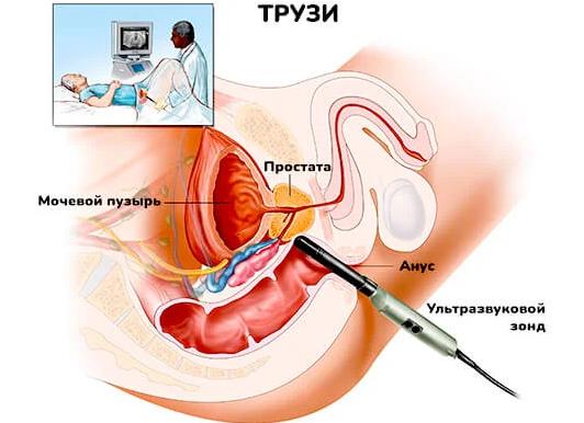 Как делается узи простаты у мужчин фото