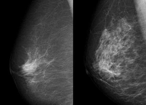 Инфильтрирующая карцинома молочной железы 2 степени
