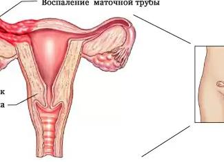 Хронический периаднексит что это такое
