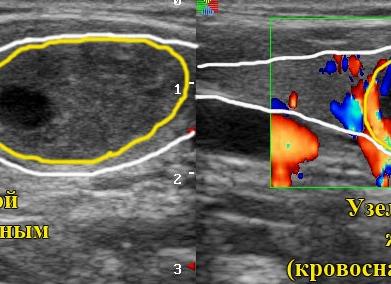 Гиперплазия щитовидной железы оценивается по Гиперплазия щитовидной железы оценивается по