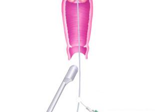 Гидросонография маточных труб