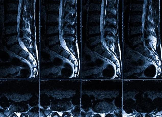 Гадолиний контраст побочные явления