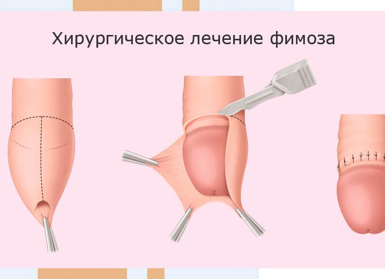 Фимоз мкб 10 у детей