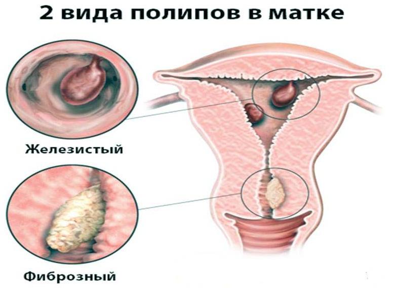 Эндометриальный железистый полип