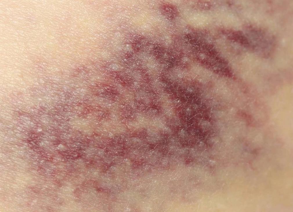 Апластическая анемия что это за болезнь