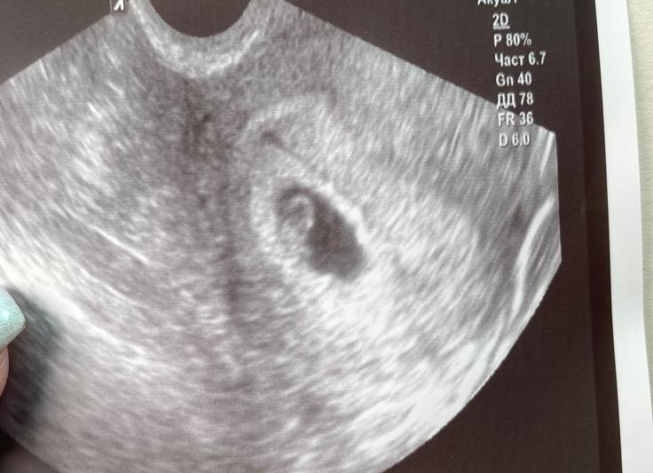 6 недель 1 день узи
