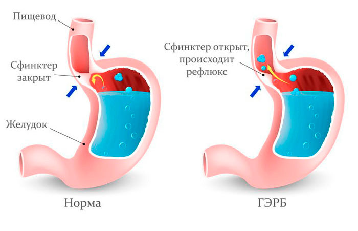 Гэрб что это за болезнь