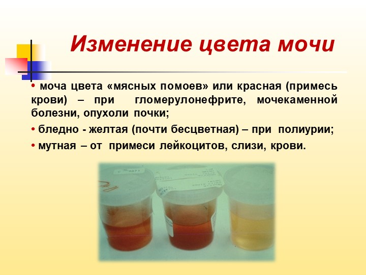 Моча цвета мясных помоев обусловлена содержанием большого количества