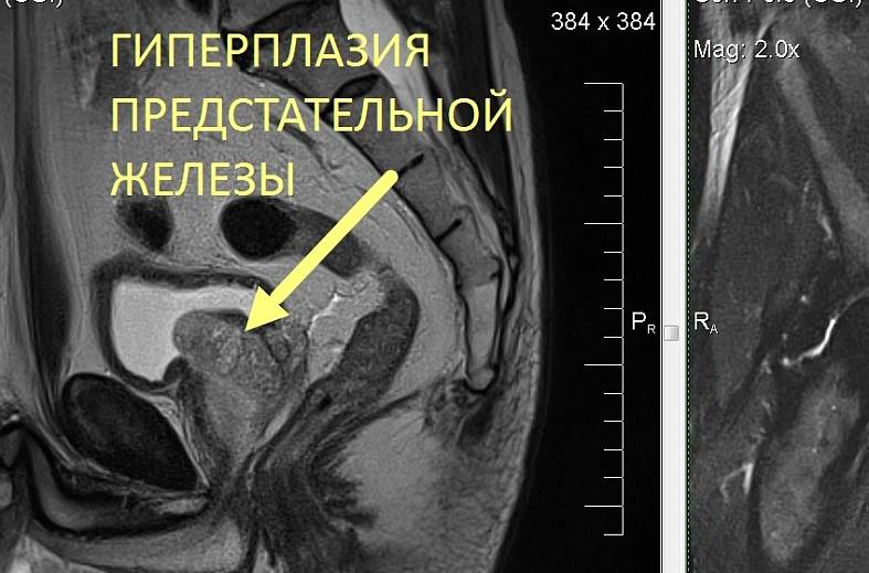 Мрт малого таза с контрастированием у мужчин