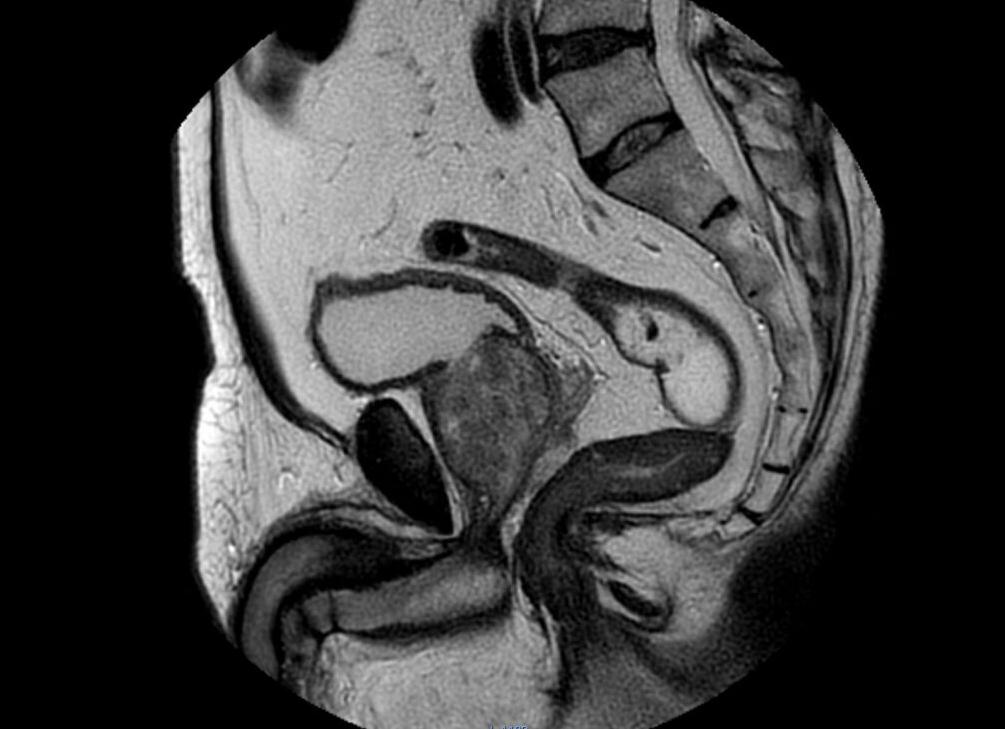 Мрт таза у мужчин