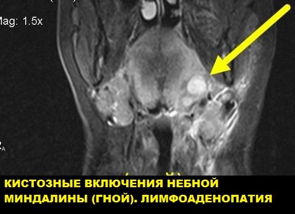 Мрт мягких тканей головы что показывает