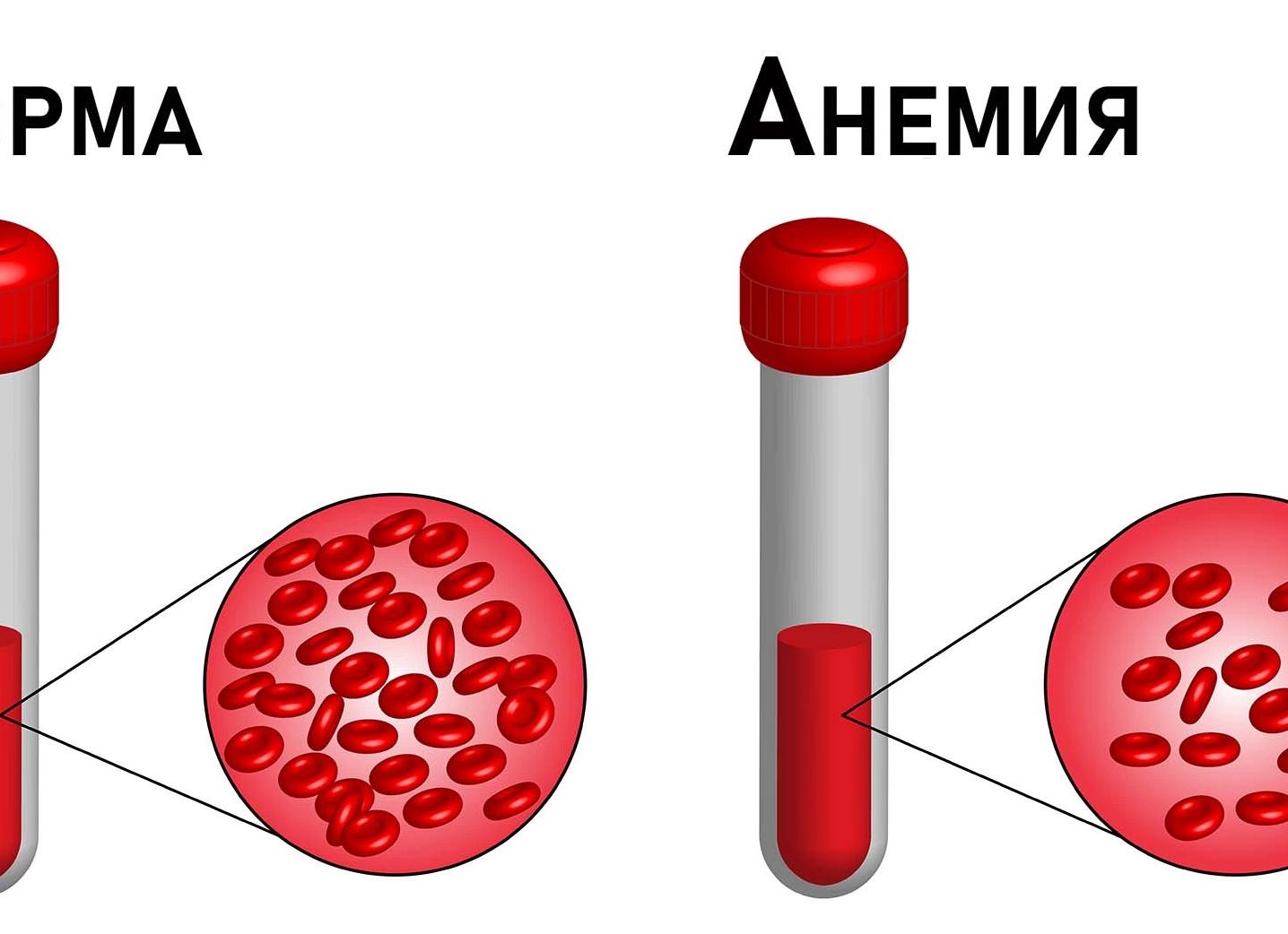 Микроцитарная анемия что это такое Микроцитарная анемия что это такое