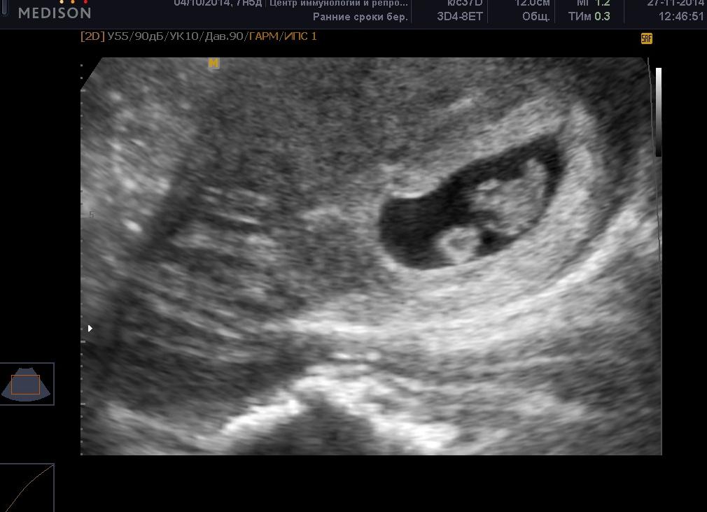 Когда можно на узи увидеть двойню