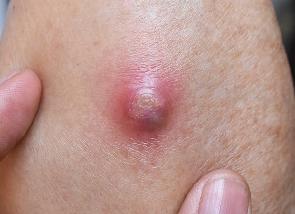 Как у взрослых проявляется стафилококк