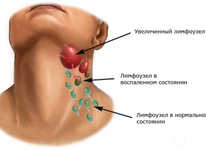 Как проявляется лейкоз Как проявляется лейкоз