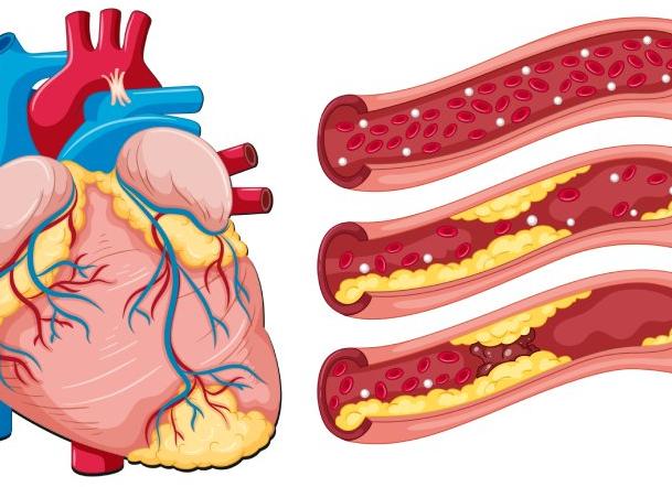 Как проверить сосуды сердца на бляшки Как проверить сосуды сердца на бляшки