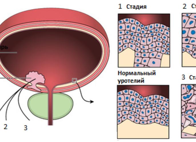 Химиотерапия при раке мочевого пузыря у мужчин