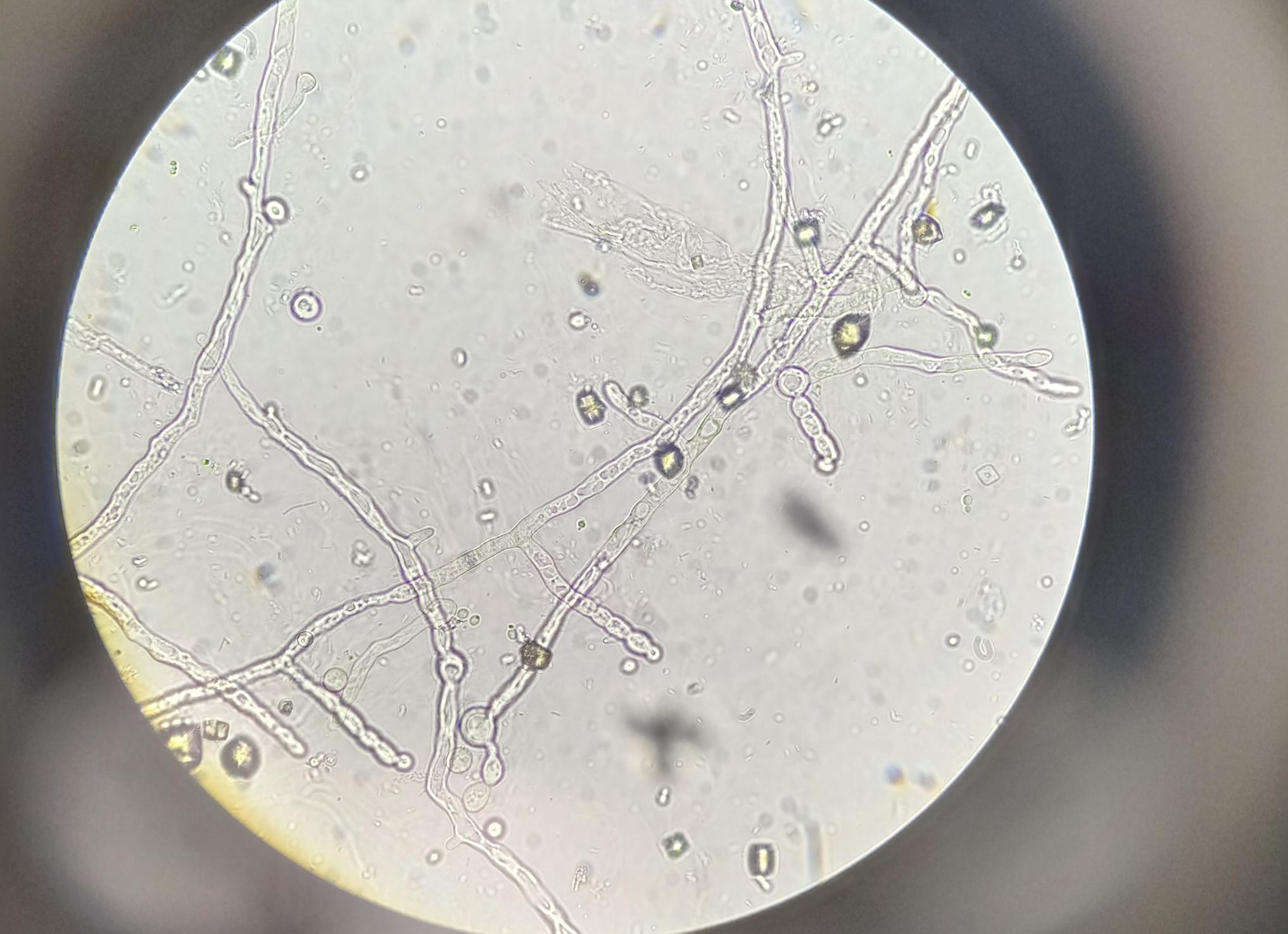 Дрожжеподобные грибы в моче