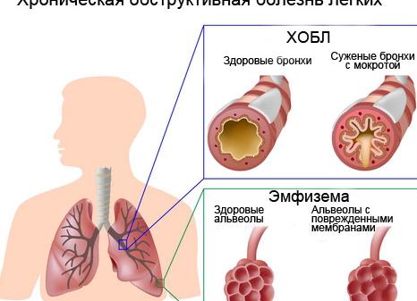 Что значит болезнь хроническая