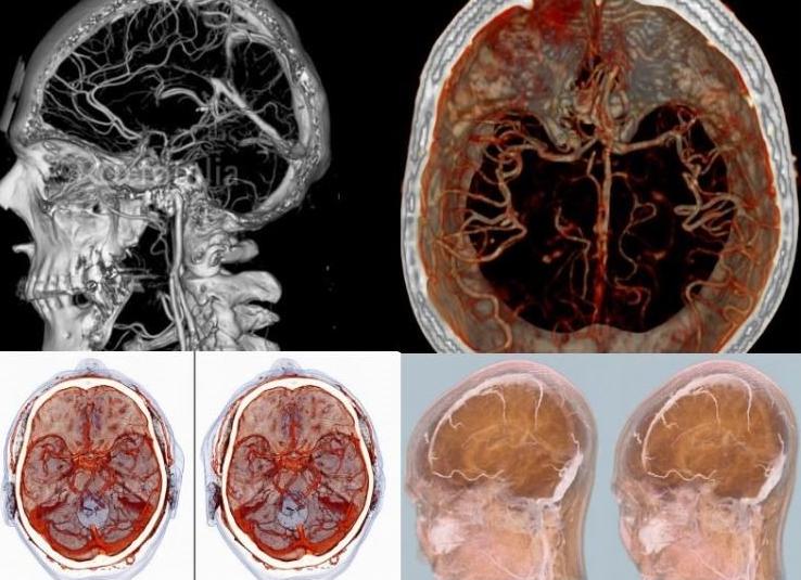Что такое ангиография головного мозга