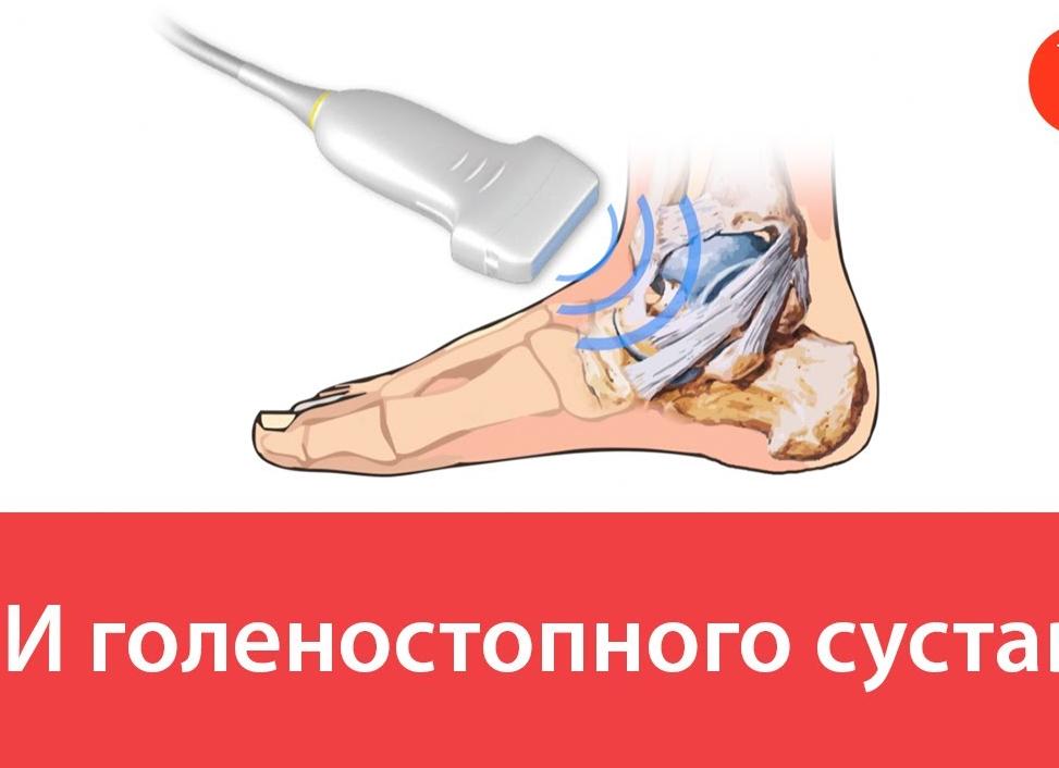 Что показывает узи голеностопа