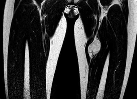 Что показывает мрт мягких тканей бедра