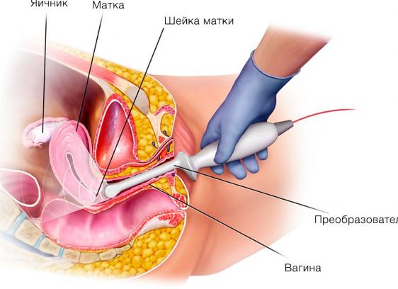 Что дает узи малого таза