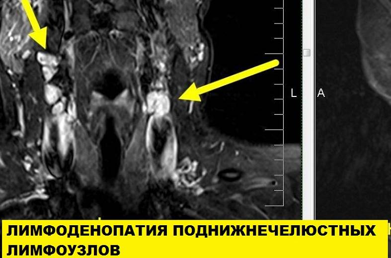 Мрт шеи мягких тканей что показывает