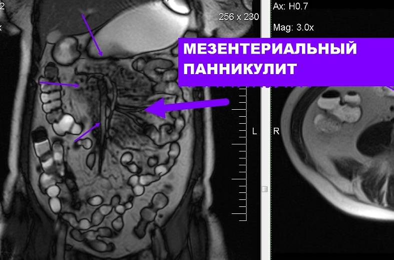 Мрт толстого и тонкого кишечника