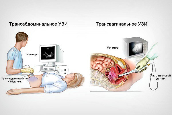 На каких сроках делают узи