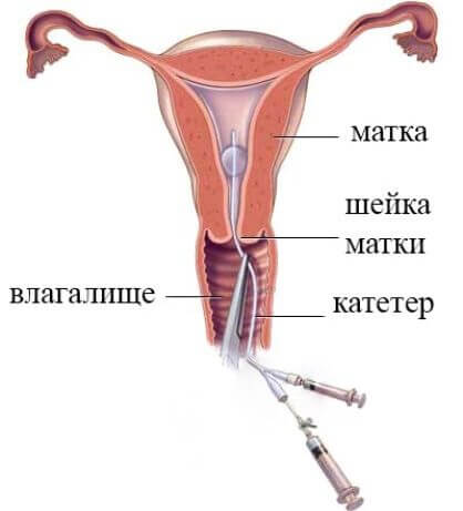 На какой день делают гсг