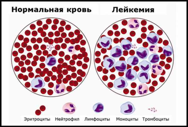 Анализ крови острый лейкоз