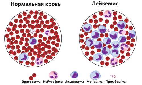 Анализ крови при лейкозе