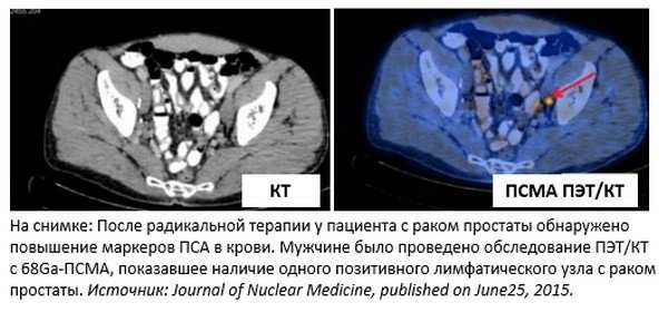 Точка простаты. Опухоль предстательной железы кт. ПЭТ кт предстательной железы с ПСМА 68. Компьютерная томография МСКТ предстательной железы. Позитронно-эмиссионная томография метастазы.