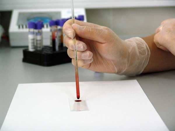 Что означает аст в биохимическом анализе крови у женщин