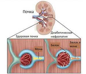 Что означает сахар в моче