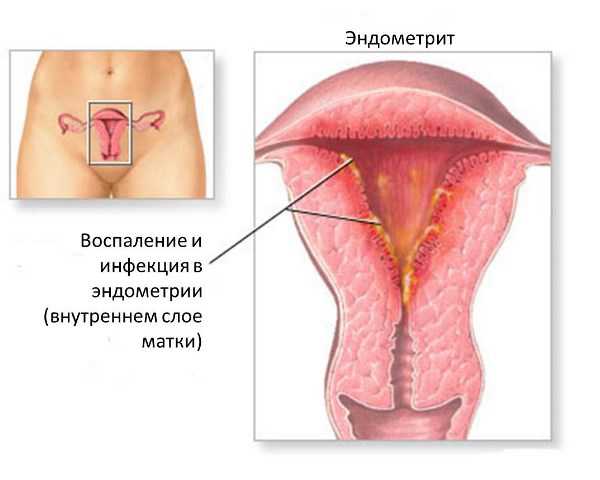 Что такое эндометрий в гинекологии