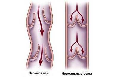 Дуплекс вен нижних конечностей что это такое