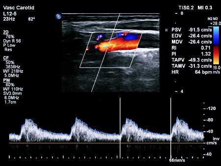 Уздс бца что это. Протокол УЗИ дуплексное сканирование брахиоцефальных артерий. Триплексное сканирование сосудов головного мозга норма. Ультразвуковая триплексное сканирование бца. Ультразвуковая допплерография экстракраниальных сосудов.